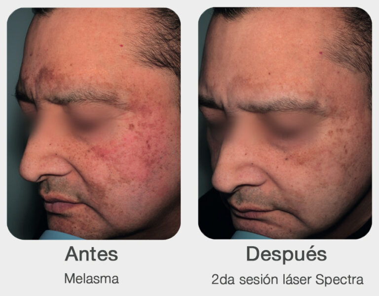 antes-y-despues-laser-para-manchas