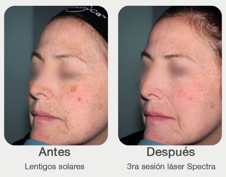 Antes-y-despues-Spectra