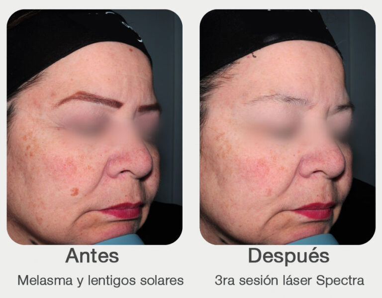antes-y-despues-2-laser-para-manchas