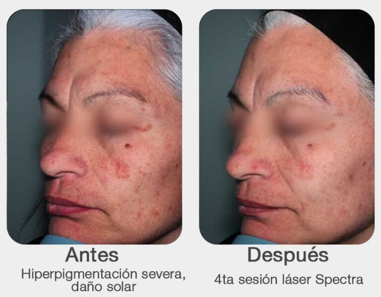antes-y-despues-3-laser-para-manchas